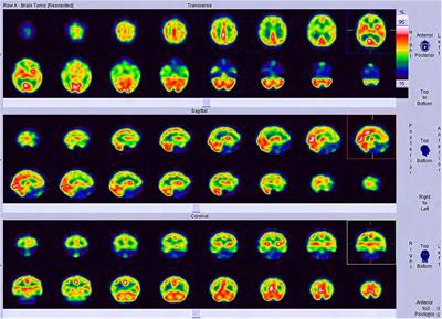 SPECT findings on neuropsychiatric symptoms caused by nitrous oxide abuse